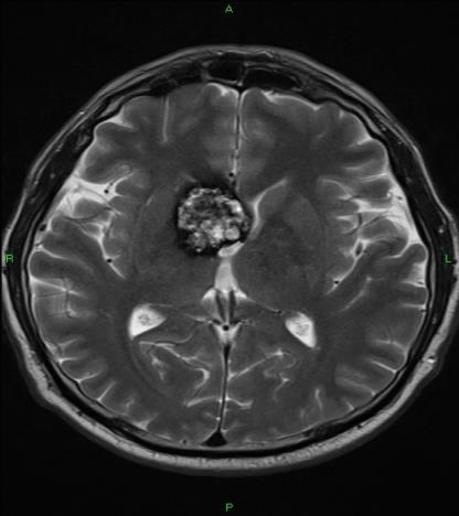 Lobaris, corticalis vérzés Etiológia: -