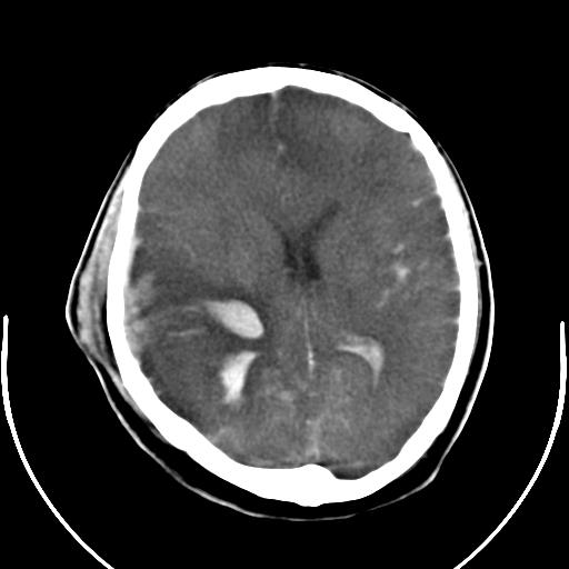 Áthatoló sérülés Contusio, sub-,epiduralis haematoma Corticalis lézió Koponyatörés