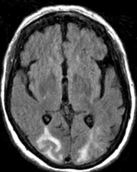 Hypertóniás krízisek Eclampsia Immunszuppresszív ágensek Patofiziológia Vasogen oedema