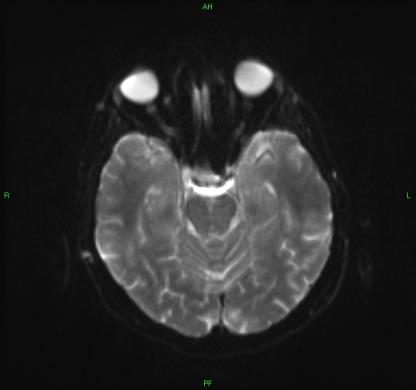 Hypoxia után 3nap - 3 hét Myoclonus /akciós, startle,tactilis/ Cerebellaris ataxia Intellektuális hanyatlás lehet Nem konzekvens EEG Anatómia: