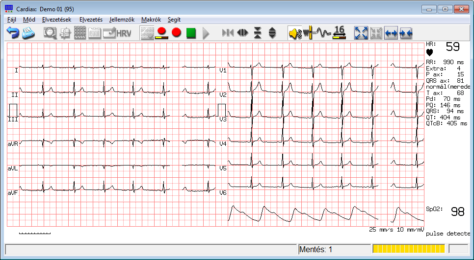 5. EKG-felvétel készítés (monitorozás) Ez a funkció az elektródákról jövő EKG jelet jeleníti meg a számítógép képernyőjén.