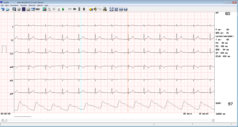 6. Eltárolt EKG felvételek 6.1 EKG-vonalzó (manuális mérés) A görbe a nullvonal-ingadozás korrigálása után jelenik meg a képernyőn.