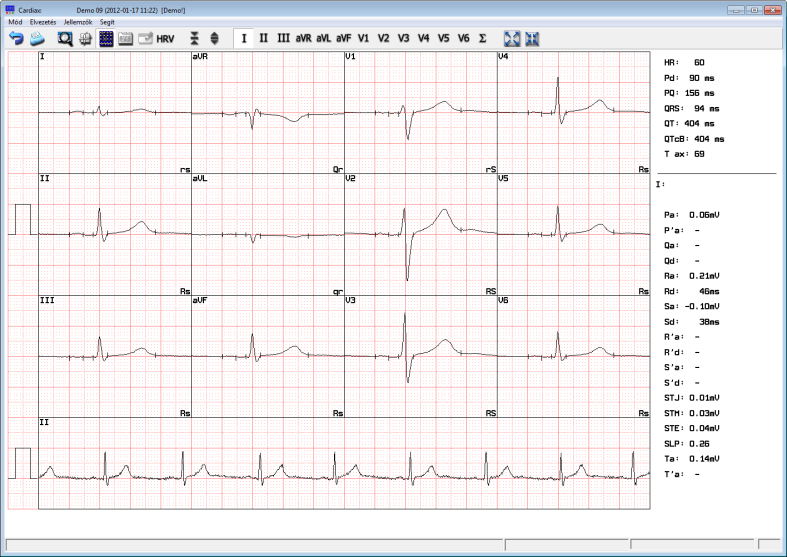 7. Az EKG felvételek kiértékelése A program az eltárolt EKG-görbék automatikus kiértékelését biztosítja.