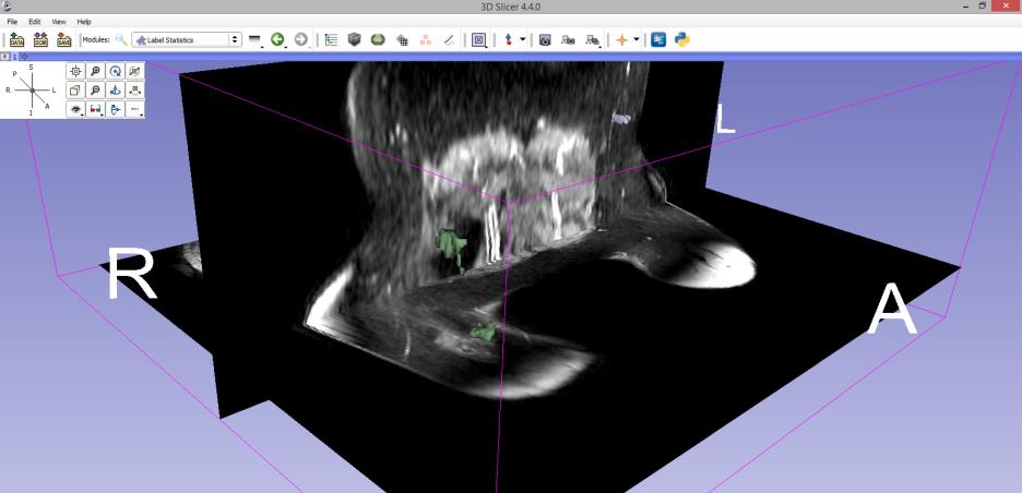 29 6.ábra: a megszerkesztett 3D-s modell a horizontális és koronális metszetekkel: