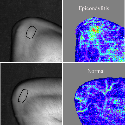 Enthesitis - Tennis Elbow Ferrell WR, Balint PV, Sturrock RD: Novel use of