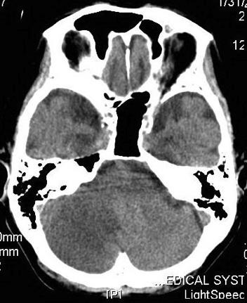 a)vertebrobasilaris ischemia képalkotó dg.: 1.