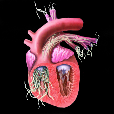 Kórfejlődés Érfal károsítás Trombus képződés Arteritis, endocarditis Jobb