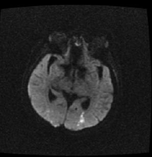 Holter negatív paroxysmalis pitvarfibrilláció A cryptogen stroke-ok 18%-ában diagnosztizálható PF/PPF a beteg emisszióját követően (SURPRISE)