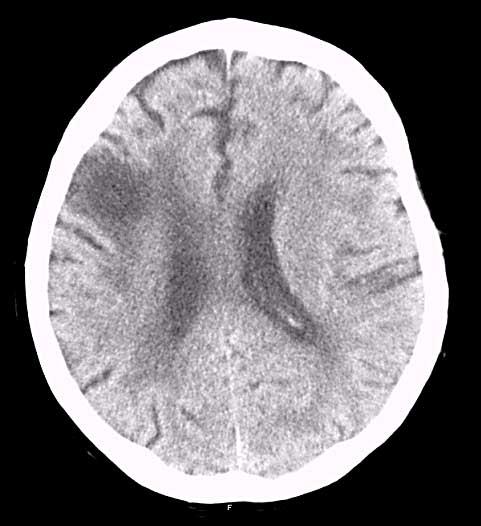 Warfarin 36% (32/90) Dabigatran 150 mg BID 35% (13/37) Dabigatran 110 mg BID 41% (12/27) Ischaemiás stroke Mortalitás 20%