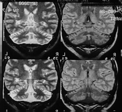 Peritrigonális noduláris heterotopia Heterotopia definiciója: normális neuronok abnormális helyen Pathomechanismus: A neuroblastok radiális migrációja a