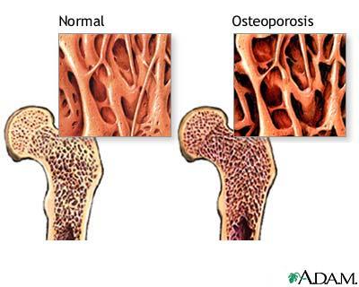 Társbetegségek arthritisekben Felgyorsult érelmeszesedés Fokozott Cv rizikó RR és lipid