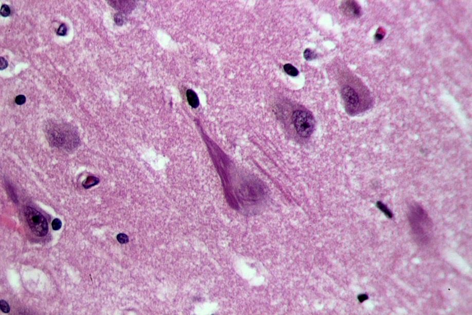 Alzheimer-kór patológiája Szenilis plakkok beta-amyloid protein neurofibrilláris kötegek hyper-phosphorylated tau (loss of synapses, dementia)