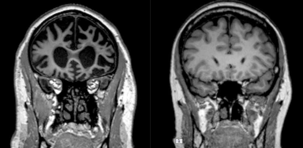 Frontotemporális neurokognitív zavar Prevalence FTNCD a 65 év alatti korosztályban gyakoribb fiatalabb betegek 2-10 / 100,000 lakos Esetek 80% -a 65 év alatti Átlagos túlélés az elő tünetek