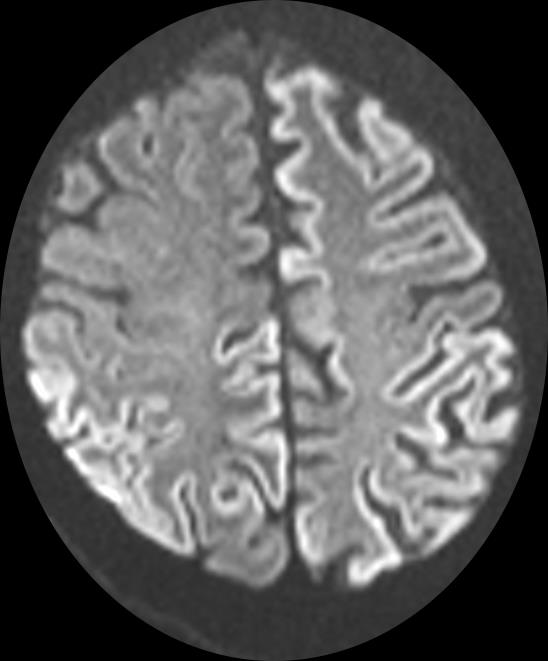 NCD prionbetegség következtében Jellegzetes tünetek MRI vizsgálaton a DWI (diffusion-weighted imaging) vagy FLAIR (fluid-attenuated inversion recovery) Multifokális