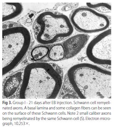 Wallerian degeneration PNS 3.