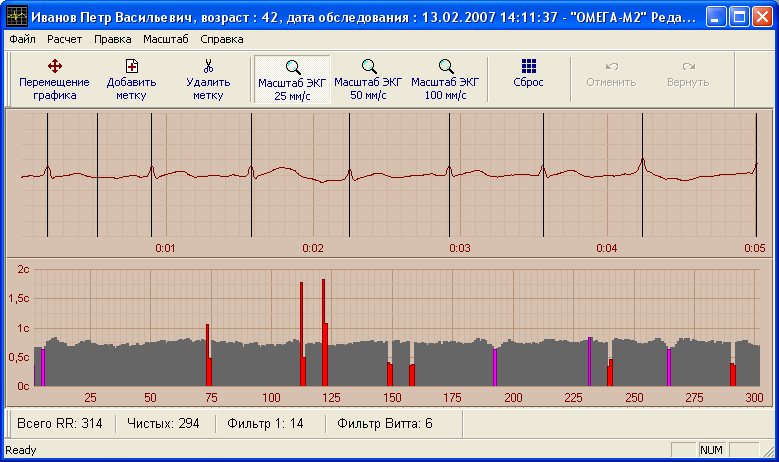 12 EKG SZERKESZTŐ Az EKG szerkesztőt az EKG jel szerkesztésére kell használni abban az esetben, ha sk zavar, extraszisztlé, vagy artefaktum lépet fel a mérés srán.