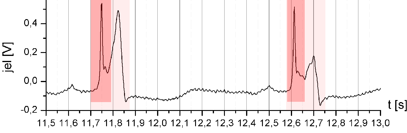 szörös (a 32. ábra példáján éppen 10-szer nagyobb) értékkel jelenik meg, mint a leválasztandó QRS-re adódó eredmény.