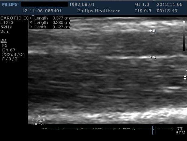 4. ábra Az arteria brachialis okklúziót követő átmérőjének meghatározása Az arteria brachialis két átmérőjéből számítható a tágulás mértéke. 6.