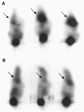 F-18 FDG PET Fluorine-18 Fluorodeoxyglucose Positron EmissionTomographyPredicts Tumor Differentiation, P-glycoprotein Expression. Clin.Cancer Res. DOI:10.