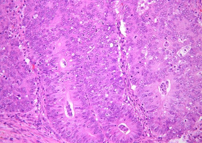 Endometrioid carcinoma Endometrialis carcinomák 80%-a FIGO grade (mucinosus is!