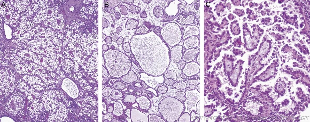 Clear cell carcinoma Szolid Tubulocysticus Papillaris Agresszív, nagyon ritka Intracitoplazmatikus