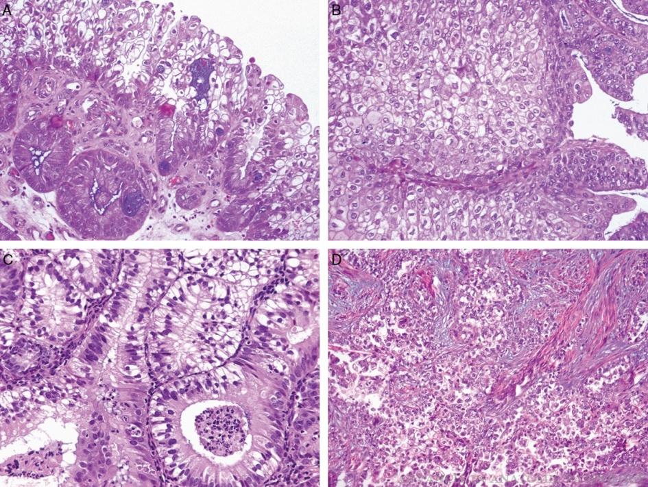 Endometrioid felszíni papillaris proliferáció Endometrioid világossejtes