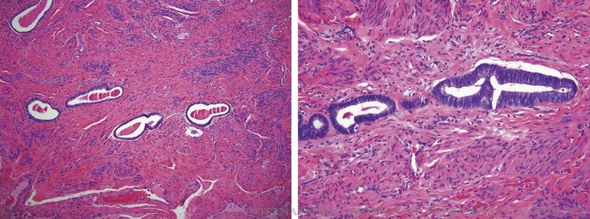 Myometrialis invázió Invázió megitélése 30% interobserver eltérés Túlélés 94% (csak endometrium) és 92% (myometrium fele) FIGO Ia Exophyticus tumorok blokk a tumor/ép határról Adenomyosis (reziduális