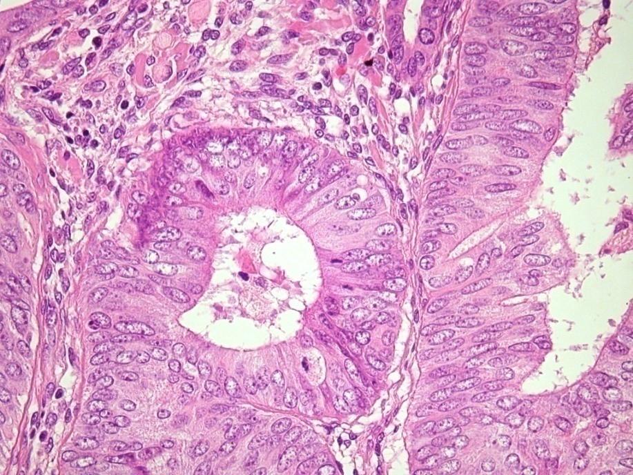 Atípusos hyperplasia Nagy, lekerekedett magok, szabálytalan magmembrán, polaritásvesztés, vezikuláris magok, prominens nucleolus Mirigyen belül minden sejtet érint Gyakran eosinophil citoplazma és