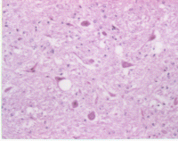 Transmissible dementias Kuru,, CJD, GSS, FFI 1. Szivacsszerő neuron degeneráci ció (spongiform vacuolation) 2. Neuron pusztulás 3.