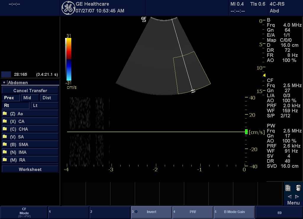 Kép optimalizálása Color Flow (CF) Mode (Színkódolt áramlás mód) Rendeltetés A Color Flow Mode (Színkódolt áramlás mód) olyan Doppler mód, amely színkódolt kvalitatív információt