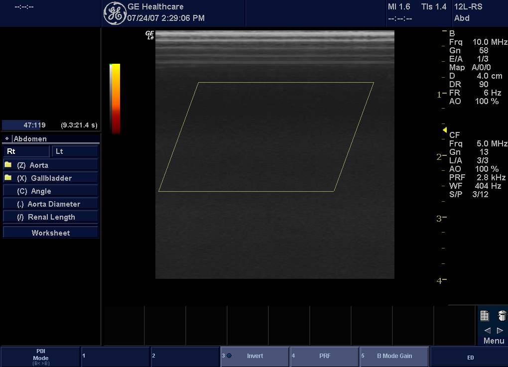 Kép optimalizálása Power Doppler Imaging (PDI) Mode (Teljesítmény Doppler képalkotás mód) Rendeltetés A Teljesítmény Doppler képalkotás (PDI) színkódolt áramlási képalkotási technika, melynek