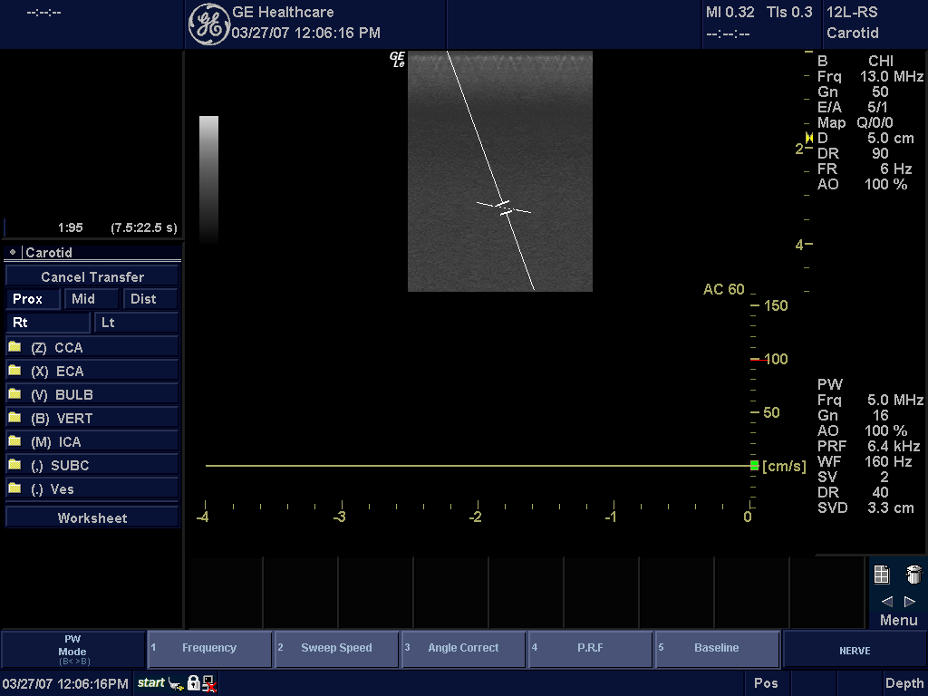 Érzéstelenítés Pulsed Wave (PW) Doppler Mode (Pulzushullám Doppler mód) Rendeltetés Ez a Doppler mód a mozgó szövetek és folyadékok sebességéről ad mérési adatokat.