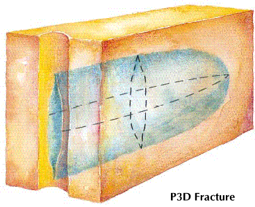 2. ábra: A létrhozott repedés geometriai jellemzése (forrás: "Introduction to hydraulic fracturing - training course" MOL) 3.