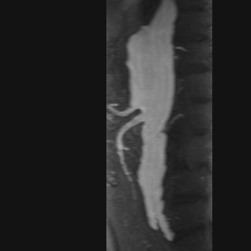 Thoraco-abdominal aortic