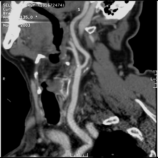 ICA stenosis CTA by 8 detector-row spiral CT (curved