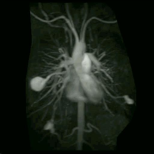 Multiplex pulmonary AVM in