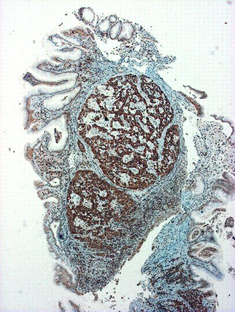 achlorhydria hypergastrinaemia,