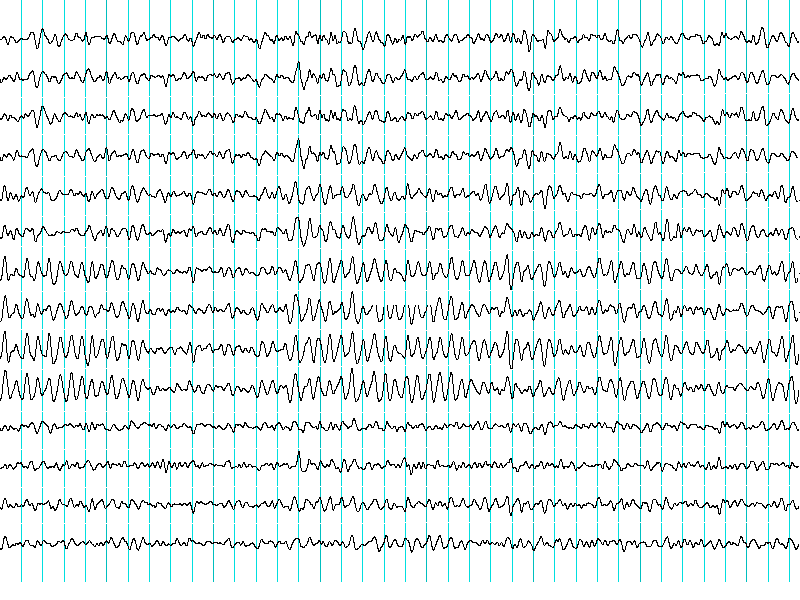 -EEG Normális