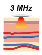 A 3 MHz-es sugár jellemzően jobban kollimált (összetart, párhuzamos), csekélyebb szöveti behatolással. Az 1 MHz-es sugár jellemzően kevésbé kollimált, de nagyobb mélységben hatol a szövetekbe.
