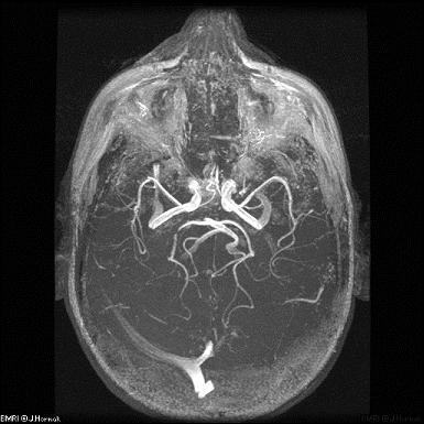 Orvosbiológiai alkalmazás - MRI Vas-oxidok: kiürülés a májon keresztül Dextránnal borított SPION-ok: klinikai