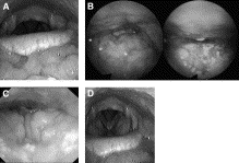 Sleep endoscopia III.