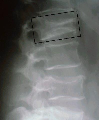 Csigolyatörések a diagnosztika problémái Még a közepesen súlyos/súlyos törések közel 60%-ában tünetmentesek * Radiológiai vizsgálatok során a csigolyatörések 30%-a (ennek ~90%-ában Grad I.