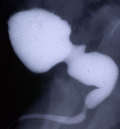 ábra Hátsó húgycső billentyű cystográfiás és endoszkópos képe Ez ideig a hátsó húgycső billentyű következtében kialakult hólyag elváltozásokat kizárólag postnatális vizsgálatokból ismertük.
