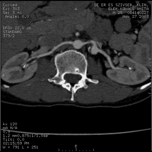 Arteria renalis aneurysma CTA