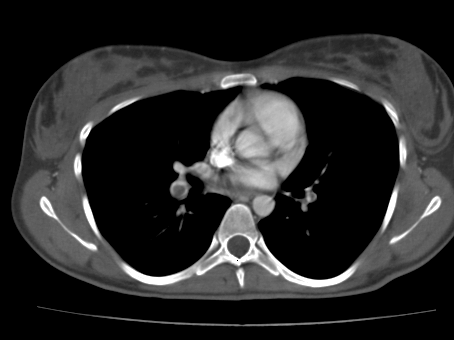 Acut pulmonalis embolia CTA