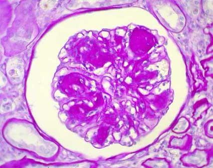 Típusos szövettani változások diabeteses nephropathiában