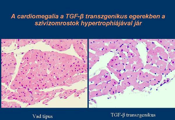 A vesefibrózis kialakulásához, és rapid progressziójához a TGF-beta fokozott expresszióján kívül más genetikai tényezők is szükségesek, melyek hiánya a fibrózis kialakulását szinte tökéletesen