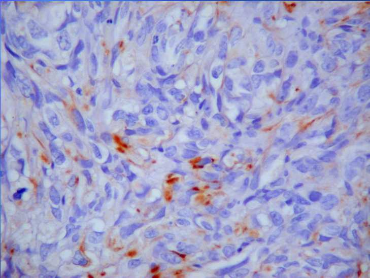 Markerek listája: CK20: gastrointestinal MELAN A: melanoma CD10: kidney carcinoma VIMENTIN