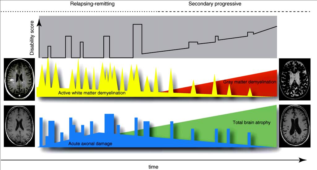 Klinikai tünetek Lefolyása Relapsus / remisszió (RRSM) Szekunder progresszív (SPSM) Demyelinisatio a fehérállományban Demyelinisatio a szürkeállományban Axon