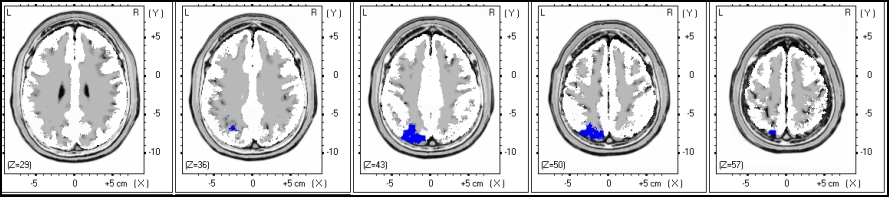 ALFA FREKVENCIASÁV (9.0-12.0 Hz) BÉTA FREKVENCIASÁV (13.0-25.0 Hz) 4. ábra. A LORETA képeken a statisztikailag szignifikáns különbségek láthatóak az alfa (9.0-12.0 Hz) és béta (13.0-25.0 Hz) frekvenciasávokban.